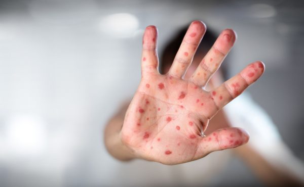 Llaman a vacunarse contra el sarampión